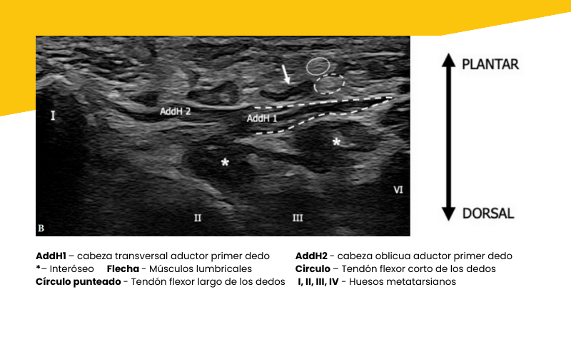 13. Musculatura intrinseca pie ecografia tempo formacion.png